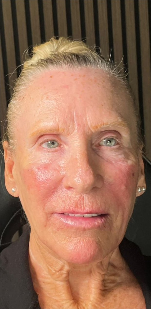 Client after facial balancing, front view
