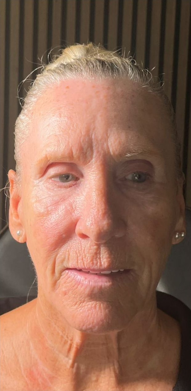 Client before facial balancing, front view