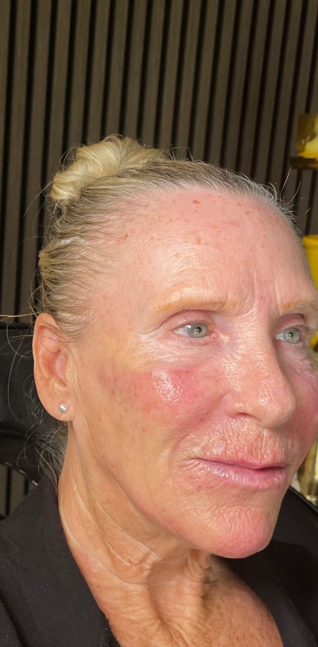 Client after facial balancing, three quarter view