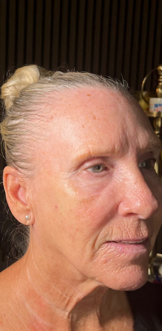 Client before facial balancing, three quarter view