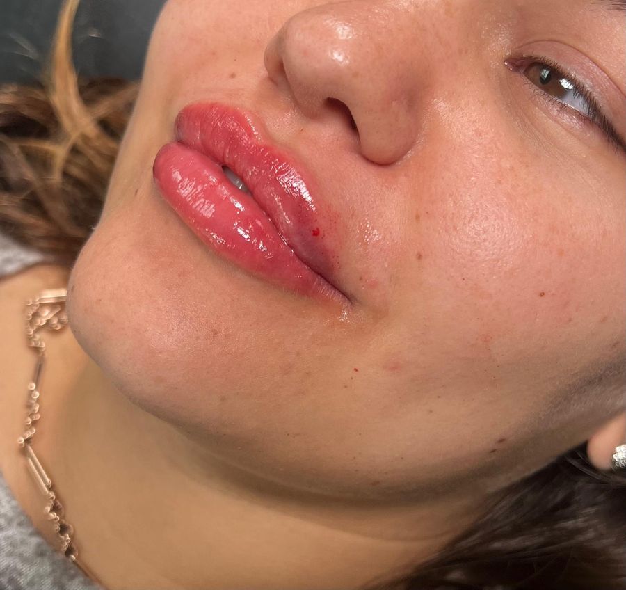 Lip augmentation result