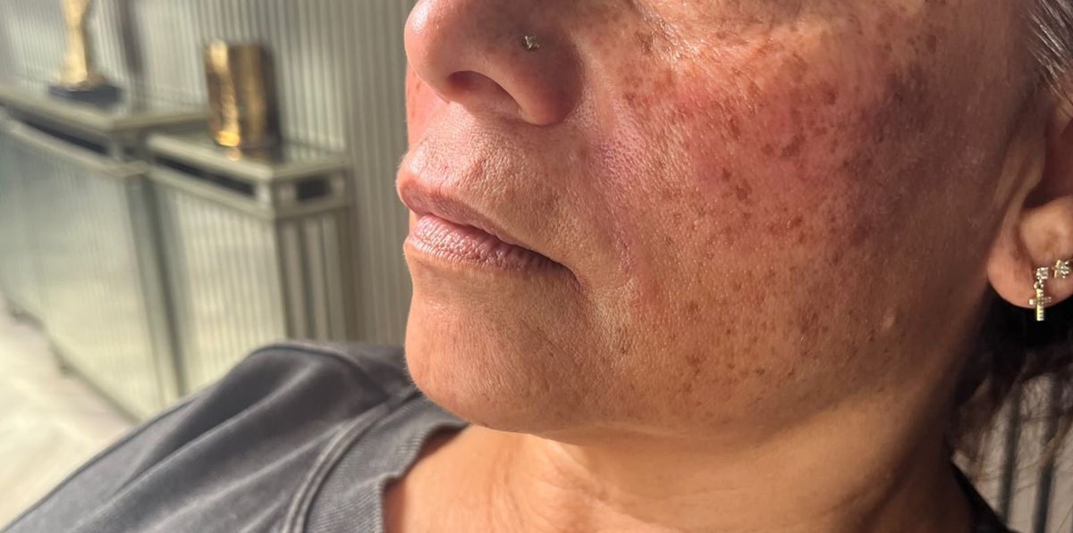 Client after nasolabial dermal filler