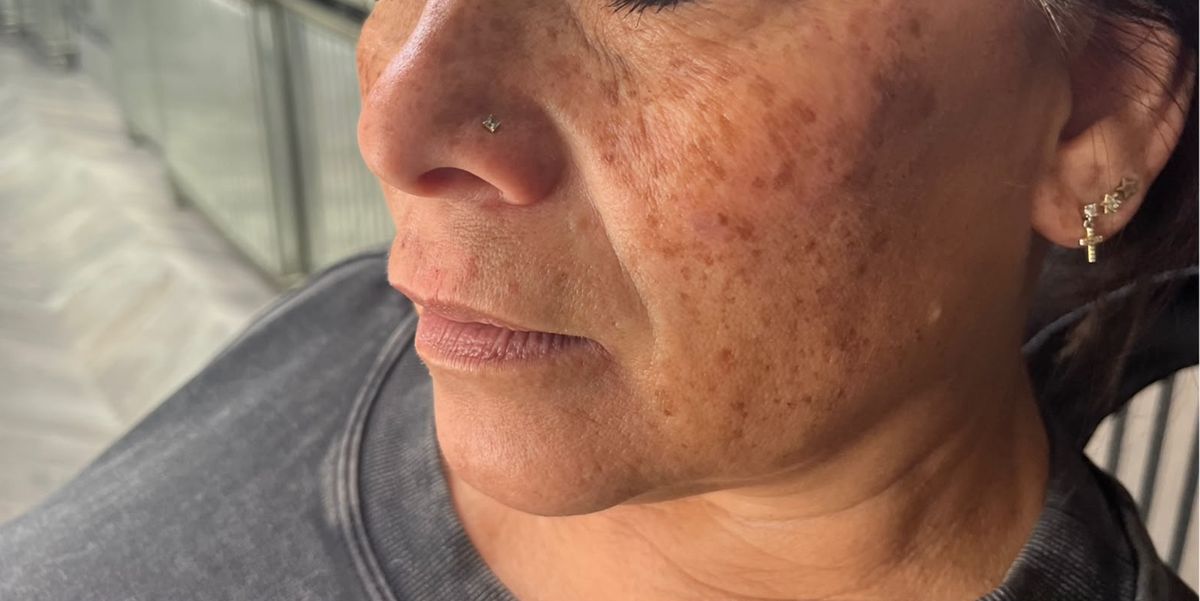 Client before nasolabial dermal filler